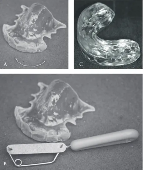 Figure 2.  Maxillary vacuum-formed retainer (VFR) and bonded mandibular  canine-to-canine retainer (Group V-CTC), maxillary VFR and mandibular  interproximal enamel reduction (S) of anterior teeth (Group V-S), and  prefabricated positioner (Group P).