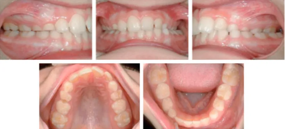 Figure  1.  Unilateral  posterior  crossbite  on  the  patient’s  left  side,  causing deviation of the mandibular midline to the left