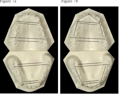 Figure 7a. The transverse linear measurements made on the study  casts in Paper II. Figure 7b