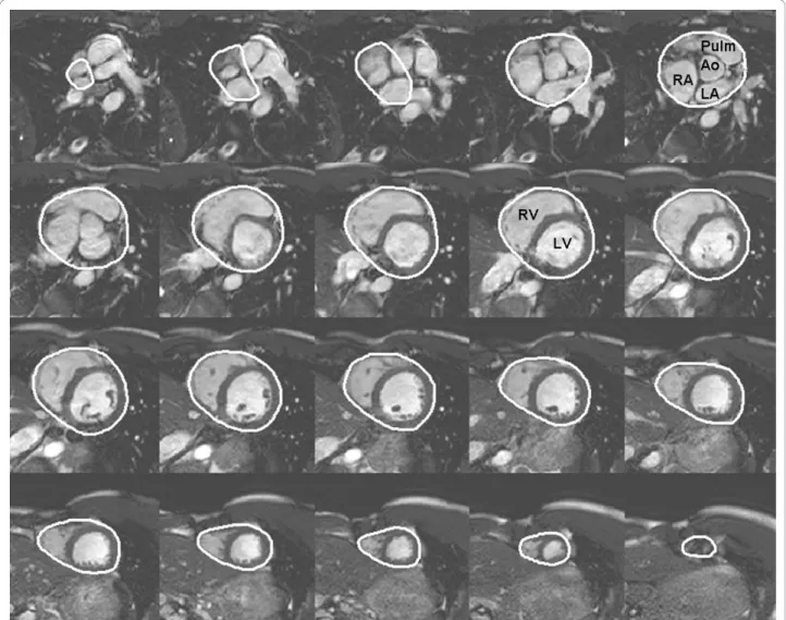 Figure 1 Delineation of total heart volume. Example of delineation of the pericardium from short-axis cardiac magnetic resonance images enabling determination of the total heart volume