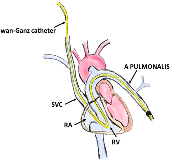 Figur 8. Visar en skissartad bild över högersidig hjärtkateterisering vid användning av en Swan- Swan-Ganz kateter