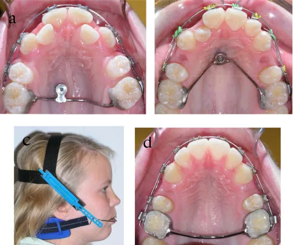 Figure 4. Occlusal view of the Onplant bar (a) and Orthosystem  implant bar (b).  Lateral view of the headgear anchorage (c) and   occlusal view of the transpalatal bar (d)