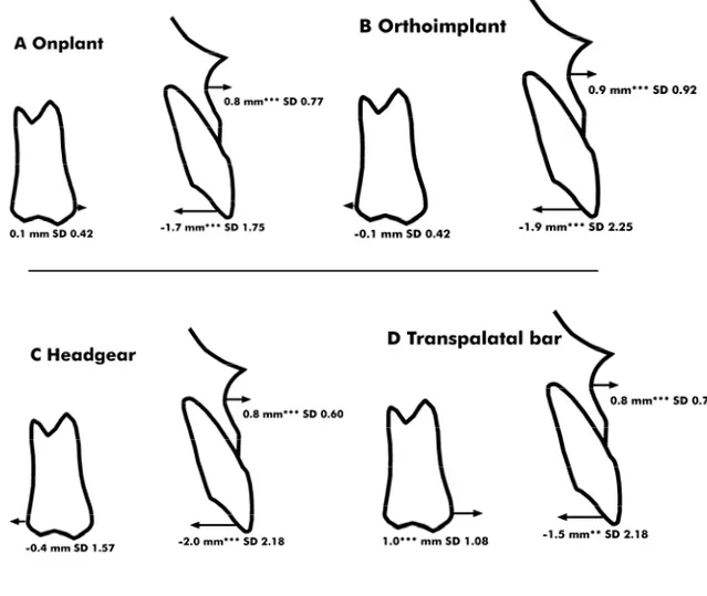 Figure 7a-d. Maxillary dental and skeletal changes (in mm) and  standard deviations (SD) contributing to alterations in the four  groups during the levelling/aligning phase