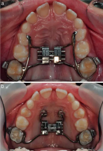 Figure 1. (a) Conventional hyrax expander; (b) hybrid hyrax expander anchored on two mini-implants in the anterior palate.