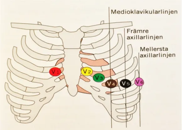 Figur 1. Elektrodplacering av bröstavledningar enligt 12-avlednings-EKG [5]. Publiceras med  författarens tillstånd