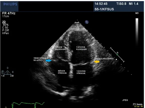 Figur 1. Stillbild över när transducern var placerad i apikal fyrkammarvy. Hjärtrummen  och klaffarna är namngivna