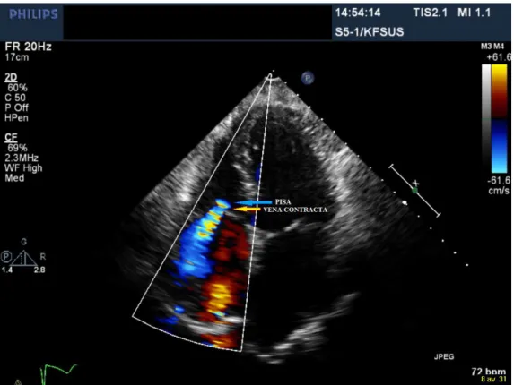 Figur 3. Stillbild i apikal fyrkammarvy över lindrig-måttlig trikuspidalisinsufficiens där  både proximal isovelocity surface area (PISA) samt vena contracta framkommer tydligt  med hjälp av färgdoppler