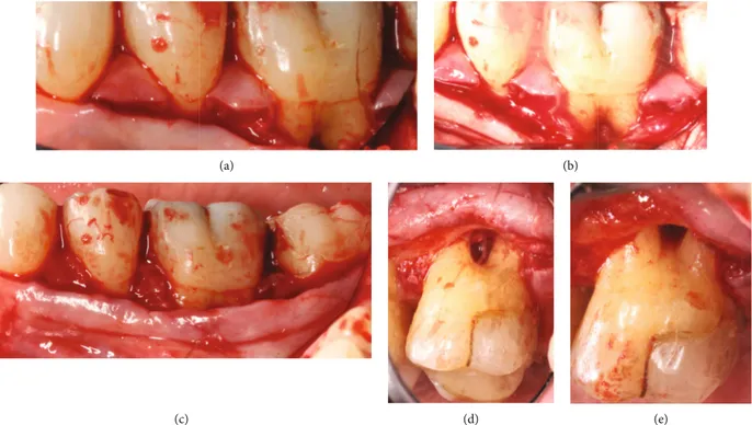 Figure 2: (a) The incision technique according to the modiﬁed papilla preservation method (MPTT) for accessing the buccal furcation in the mandibular molars (region 37-35)