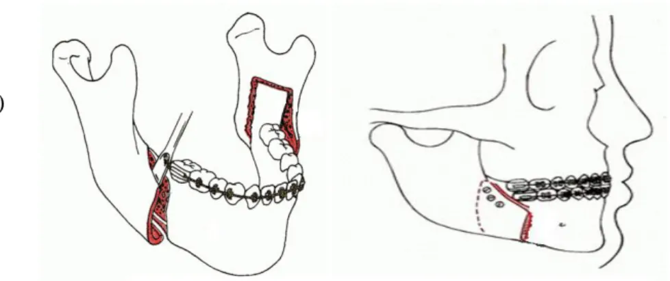 Figur 6: Le Fort I osteotomi Figur 5: Intraoral vertikal ramus osteotomi (IVRO)Figur 4: Bilateral sagittal split ramus osteotomi (SSRO)