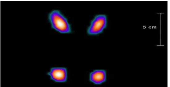 Figur 4. Exempel på ett automatiskt ROI beräknat utifrån SPECT/CT-data. Bilden redogör för ett  coronalsnitt (överst) och transversalsnitt (nederst)