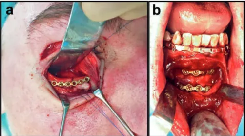 Figure  2:  Surgical  images  of  internal  fixation  of  facial  fractures.   Metallic  plates  and  screws  bare  the  load  during  healing  of  the  bony  segments