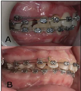 Fig 2. Space closure: A, with miniscrew and closed-coil spring; B, with molar block and active tie-back.