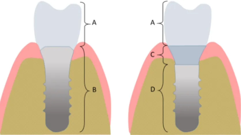 Figure 2. A: Implant-supported single crown, B: Tissue-level implant,   C: Abutment, D: Bone-level implant