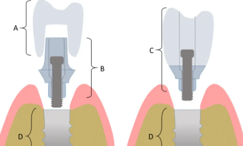 Figure 3. A: Cement retained implant-supported single crown, B: Abutment,  C: Screw retained SC, D: Dental implant 