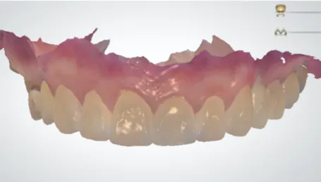 Figure 7. IOS 3D dataset of a maxillary dentition. Capturing tooth and  gingiva form.