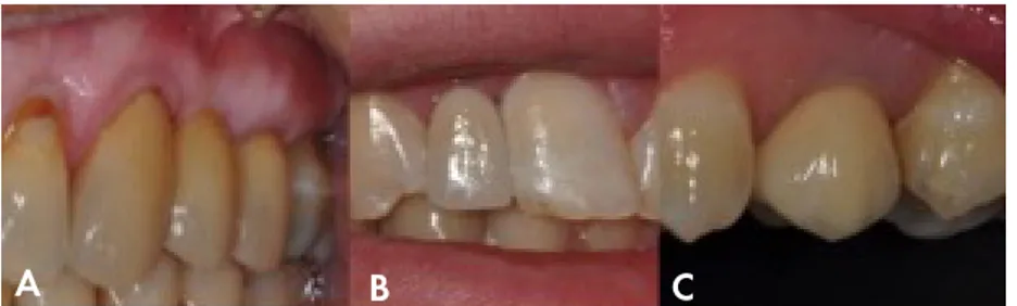 Figure 9. A: Fixed dental prosthesis 23 to 25. B: resin-bonded bridge 12.   C: Implant-supported SC 25.