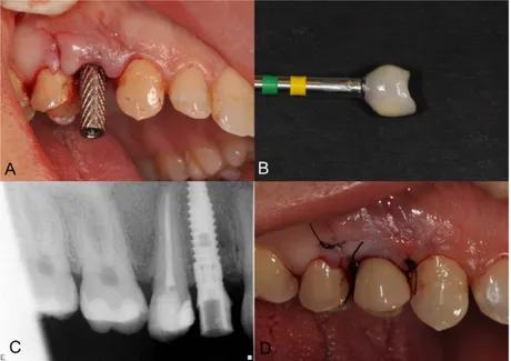 Figure 14. Temporary crown IL (A) Titanium temporary abutment;   (B) Temporary crown after polishing; (C) Radiograph of temporary crown;  (D) Temporary crown seated and mucosa sutured.