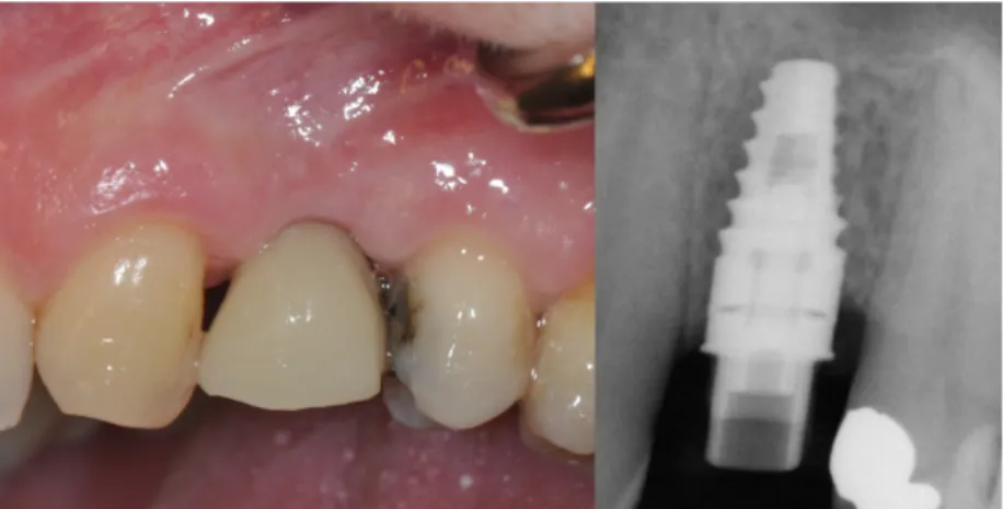 Figure 16. 3D printed temporary crown and radiograph of titanium base  abutment.