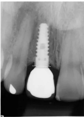 Figure 2. Marginal bone level measurement. A reference line is drawn at the implant-abutment  junction from where the mesial and distal marginal bone levels are measured