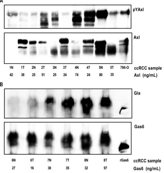 Figure 1. Axl is phosphorylated and Gas6 is c-carboxylated in human ccRCC tissue. Homogenized tissue lysates from a panel (patient one to eight) of matched ccRCC tissues and unaffected kidney cortex counterparts were used for Axl (A) and Gas6 (B) immunopre