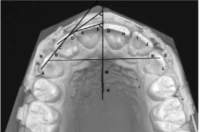 Figure 12. Showing the tooth angles on the right side to raphe line and intercanine  distance