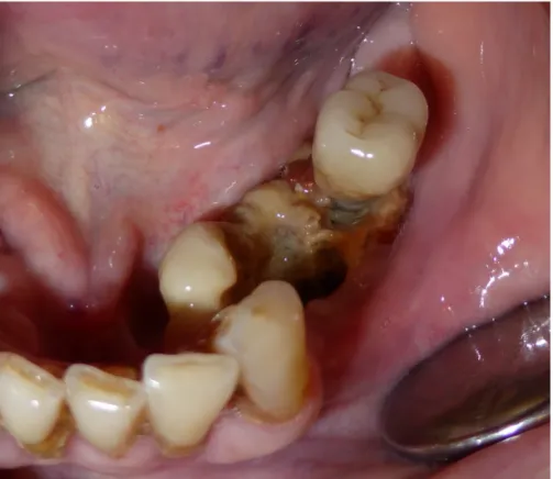 Figure 1. Exposed necrotic bone involving the tori in the mandible  in patient nr 22. 