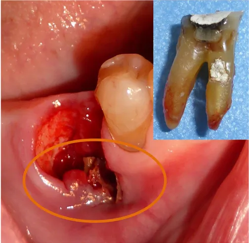Figure  3.  Marginal  periodontitis  as  the  initiating  factor  demon- demon-strating exposed necrotic bone with an established MRONJ lesion  at the time of the extraction