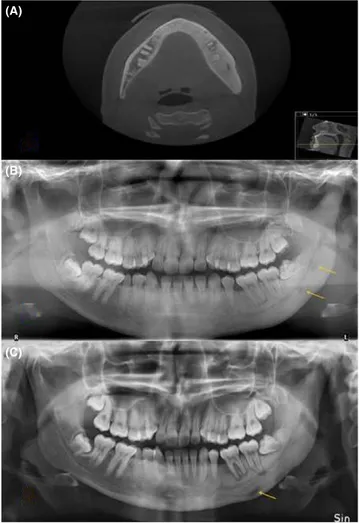 FIGURE 1  Radiological examinations of a 21‐year‐old woman  with diffuse sclerosing osteomyelitis of the left side of the mandible  treated with cortisone and analgesics for five years