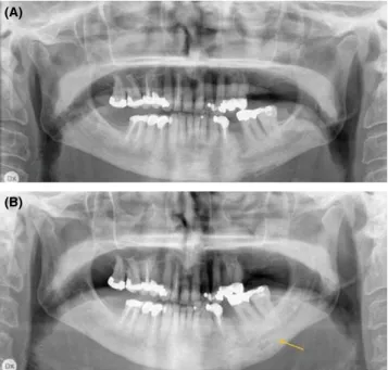 FIGURE 2  Radiological examinations of a 71‐year‐old woman  with diffuse sclerosing osteomyelitis of the left side of the mandible for  two years, treated with corticosteroids and clindamycin for two years