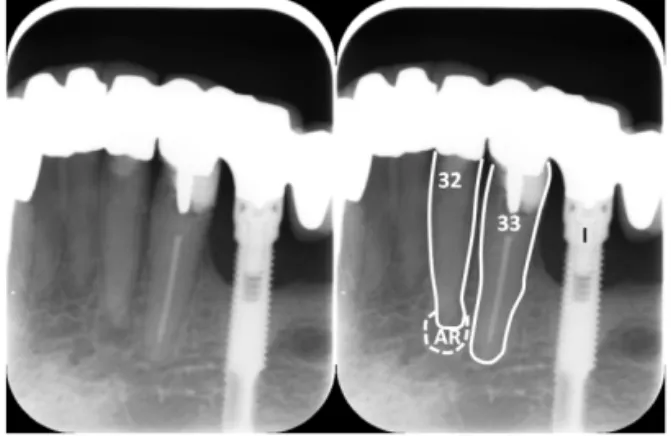 Figure  1  –  Intra-oral  radiograph  showing  an  apical  radiolucency  that  reveals  pathological bone destruction