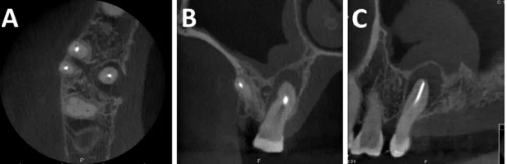 Figure 3 – Tomograms of a CBCT examination requested pre-surgically for a  first  right  maxillary  root-filled  molar  with  an  unresolving  palatal  sinus  tract,  showing the extent of an apical radiolucency around the palatal root  fenestrat-ing the c