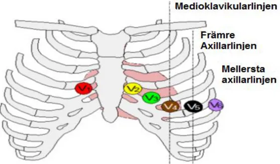 Figur 2. Elektrodplacering av bröstelektroder. V1 placeras i 4:e revbensmellanrummet vid högra  bröstbenskanet, V2 i 4:e revbensmellanrummet vid vänstra bröstbenskanten, V3 diagonalt mellan  V2 och V4, V4 i 5:e revbensmellanrummet i mediok-clavikularlinjen