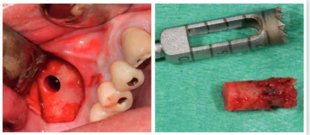 figure 4. Eight months after lateral ridge augmentation, Astra osseospeed implants were  placed and biopsies were retrieved from both DPBB:AB compositions perpendicular to  figure 3