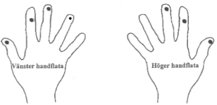 Figur 1. Placering av thermoluminiscenta dosimetrar över de mest utsätta fingertopparna.