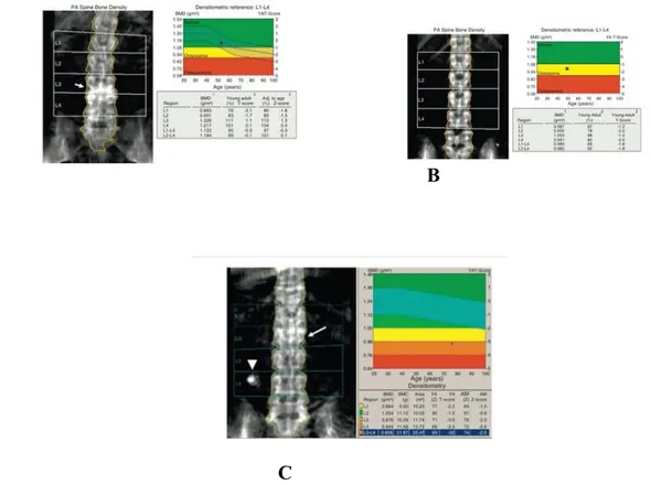 Figur 3. Visar DXA-mätningar för ländrygg L1-L4 vid normal BMD (A), osteopeni (B) och osteoporos (C)  [14]