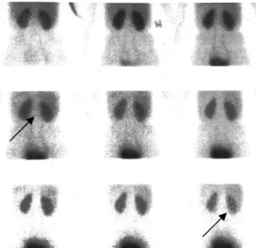 Figur 2. Normalt renografi med framtagna tvåminutersbilder som visar det maximala upptaget i  njurarna, som därefter ansamlas i urinblåsan [1]