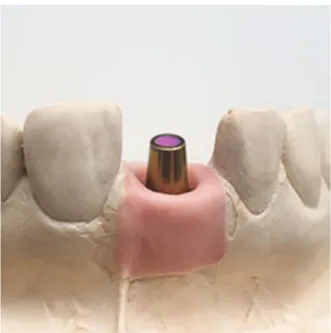 Fig. 2 Composite lid. Zirconia crown with composite covered venting holes.