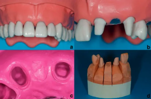 Figure 4 (a-d).  Master model production: (a-b) Plastic model with two abut- abut-ment preparations, (c) Impression of plastic model, (d) Master cast in die  stone