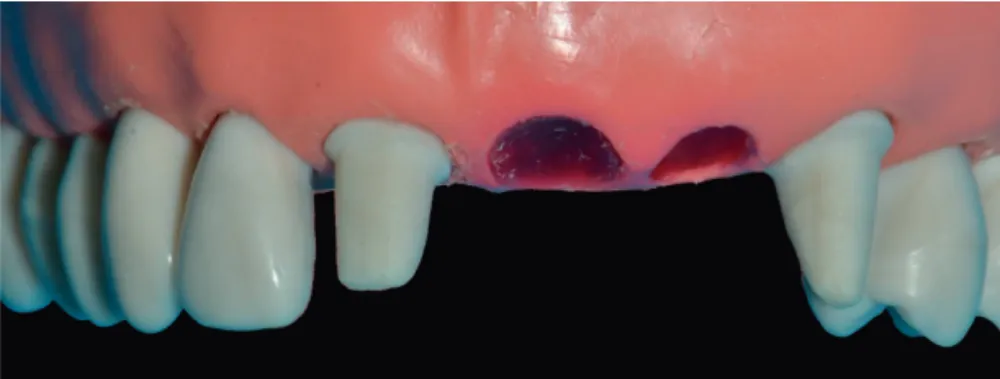 Figure 6.  A plastic model with two abutment preparations, incisor 11 and  canine 23, for preparation of the four-unit master cast