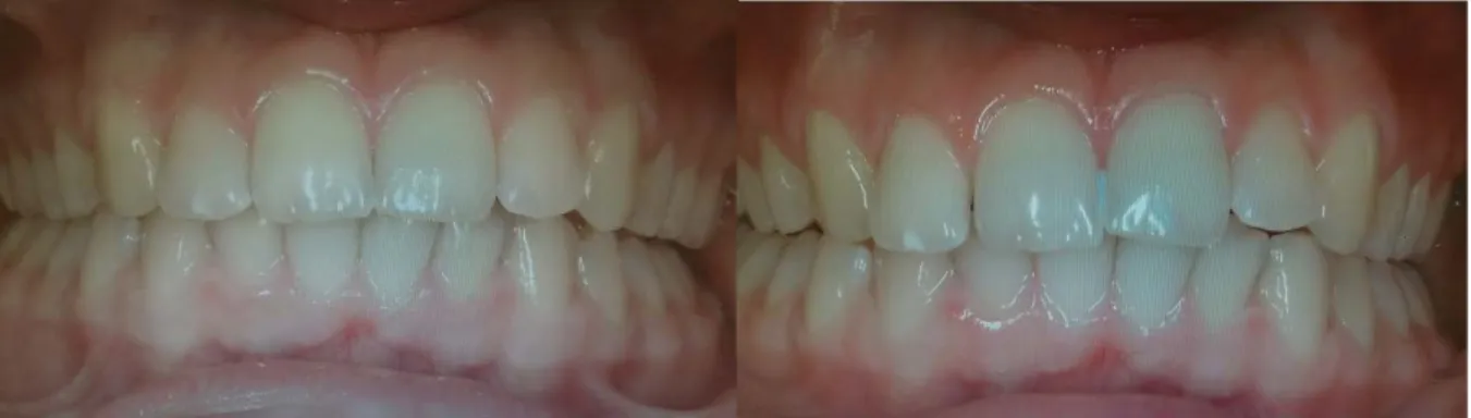 Figure 4.  Detection  of gingival recession on intraoral photographs were performed on a computer screen.