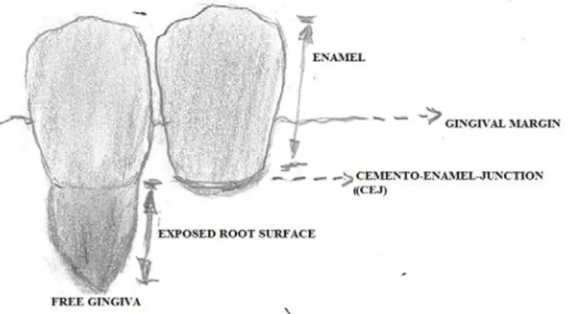 Figure 1. Tooth on the left has got a gingival recession. Copyright: Dan Håkansson 