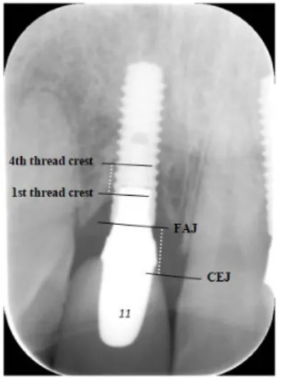 Figure 5. The fixture-abutment junction (FAJ) and cemento-enamel junction (CEJ) at the adjacent tooth was  marked with parallel lines as well as the 1st and 4th thread crest of the implant