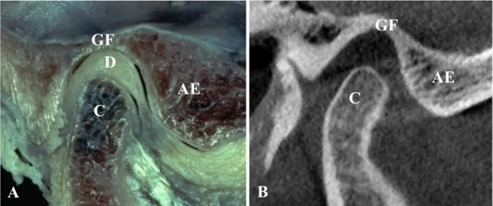 Figure  1.  The  temporomandibular  joint.  (A)  Photograph  of  an  anatomical  dissection  (reprinted  with  permission  from  Lars  Eriksson  and  Per-Lennart  Westesson),  and  (B)  A  radiographic  image