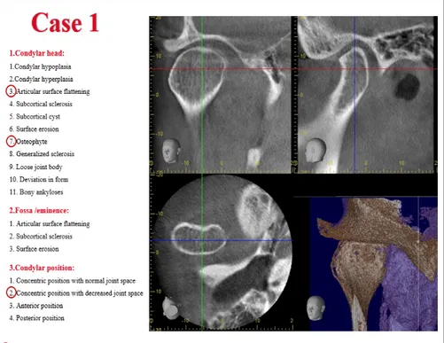 Figure 4. A screenshot of the educational tool that presented in Study I  for  the  assessment  of  TMJ  osseous  tissues  in  2D  pre-defined  CBCT 