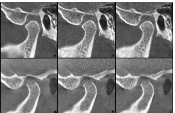 Figure 1  Examples of cone beam CT images for two temporomandibular joints using the three protocols (a) default, manufacturer recom- recom-mended, (b) low- dose and (c) processed low- dose