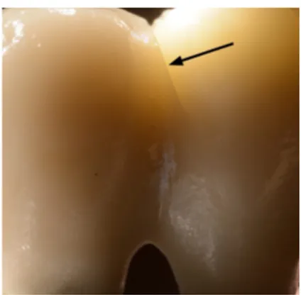 Figure 7 A visible crack in the  porcelain (arrow) 