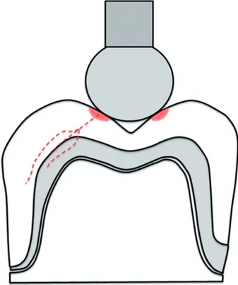 Figure 2. Application of the load aligned with the core-veneer interface, tangentially to the highest point of curvature between the buccal and the occlusal cusps