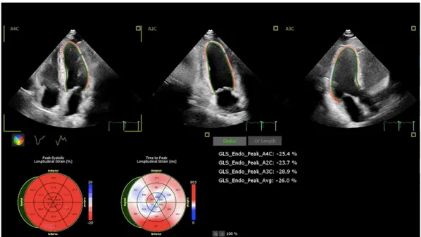 Figur 3. Exempel på speckle tracking i apikal 4C vy, apikal 2C och APLA vy samt bull’s eye plot  med TomTec