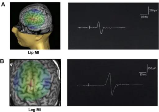 Fig. 2. Motor evoked potentials of the right orbicularis oris muscle (A) and tibialis anterior muscle (B) resulting from cortical single-pulse transcranial magnetic stimulation of the contralateral lip and leg primary motor cortex (MI) respectively.