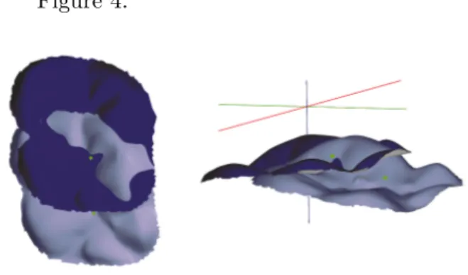 Figure 4: Pre- and post-treatment position of tooth 16s occlusal surface.